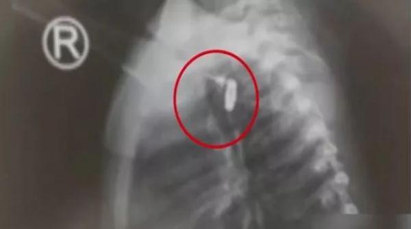 1岁宝宝哭闹，医生一看惊呆！妈妈身上这东西竟被他吞下