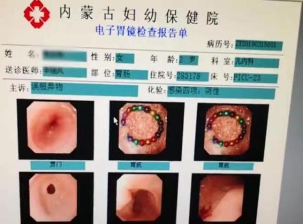 警惕!呼和浩特一2岁女童吞18颗磁力珠 在胃里连成串