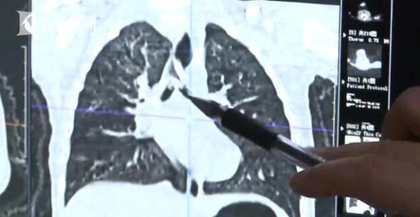 1岁宝宝突然说不出话眼睛翻白 糊涂父母2次错失机会险送孩子性命