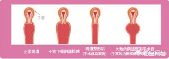 曾做过宿阴手术，现在怀孕了还可以顺产吗？