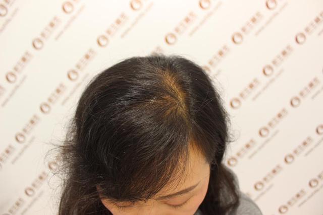 产后3个月开始脱发，头皮都看见，怎么办？