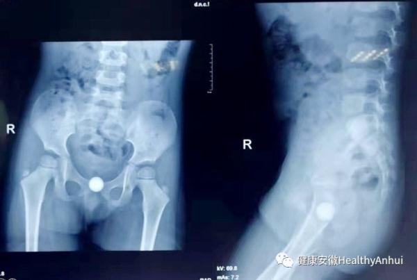 3岁女童下体取出玻璃球，专家支招应对孩子性“好奇”