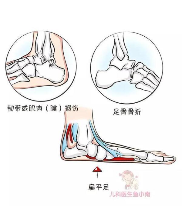 如何给宝宝挑鞋子？宝宝扁平足怎么回事？太多细节你都需要知道
