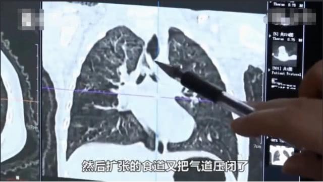 1岁宝宝气管被堵塞，眼睛翻白差点断气，元凶是家里的这个零食