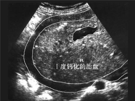 胎盘钙化和胎盘老化，哪一个对胎儿危害大？