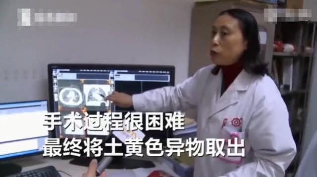 1岁宝宝气管被堵塞，眼睛翻白差点断气，元凶是家里的这个零食