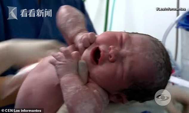 哥伦比亚降生“胎中胎”双胞胎 妹妹长在姐姐腹中