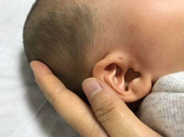 宝宝耳朵上有小孔，并非是福气象征，这种情况下，家长别大意