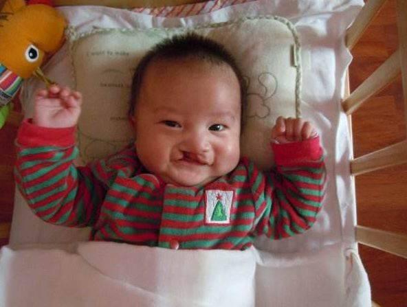 产检胎儿是兔唇，妈妈坚持把他生下，几个月后孩子变化令人惊喜