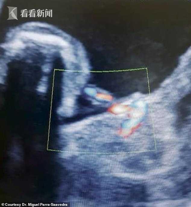 哥伦比亚降生“胎中胎”双胞胎 妹妹长在姐姐腹中