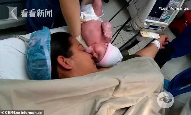 哥伦比亚降生“胎中胎”双胞胎 妹妹长在姐姐腹中