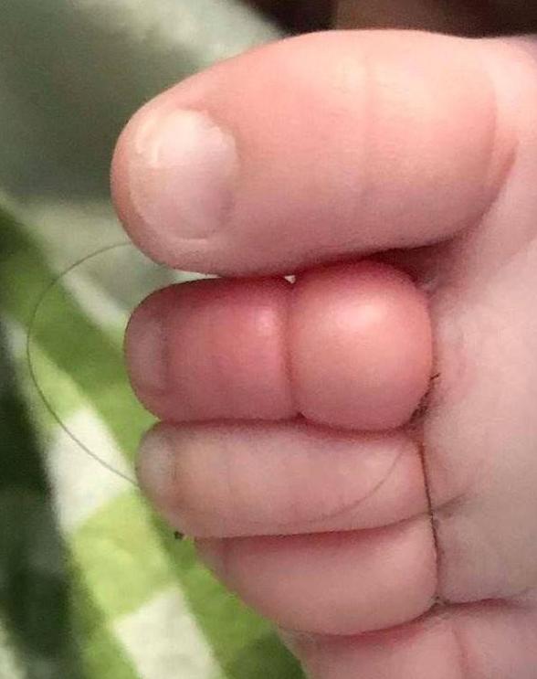婴儿脚趾被母亲的头发缠住12小时，险些遭到截肢
