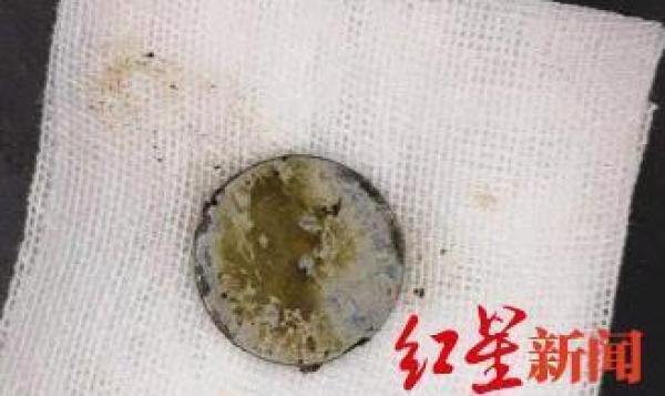 误吞纽扣电池11个月大婴儿食管被灼伤