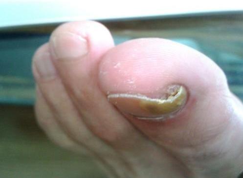 脚趾甲长到肉里面真麻烦,医生教你正确处理,消肿止疼还不复发