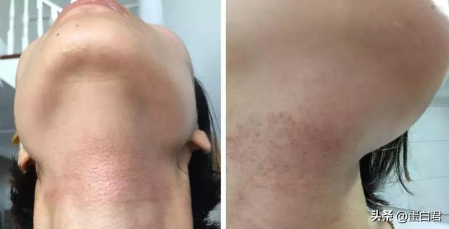 干货 | 换季易过敏！抗敏专家陈湘青正在直播，拯救痛苦过敏！