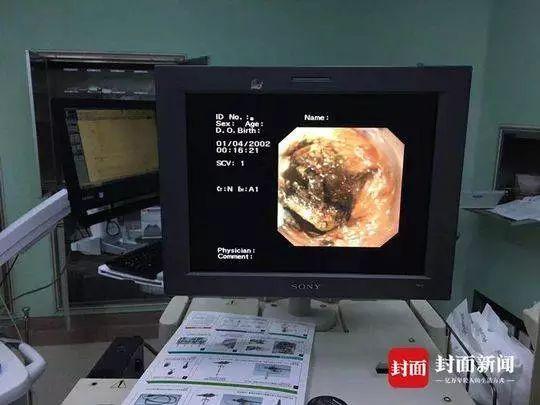 揪心！不满1岁婴儿食管被腐蚀，只因误吞……这东西很多人家里都有