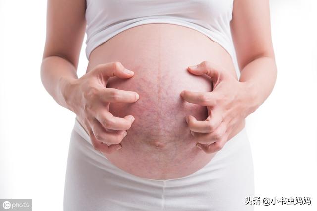 妊娠纹会伴随你一生吗？孕妇孕期做好这3点很重要，能预防妊娠纹