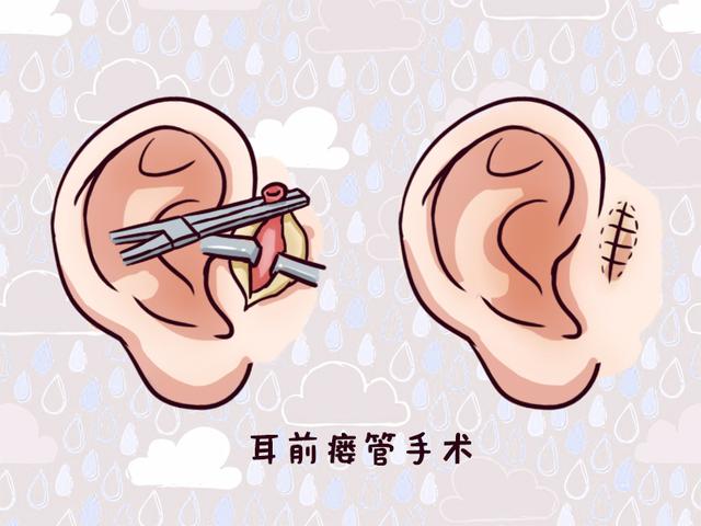 宝宝耳朵上的小孔说明有福气？儿科医生说出实情，爸妈心里要有数