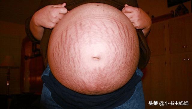 妊娠纹会伴随你一生吗？孕妇孕期做好这3点很重要，能预防妊娠纹