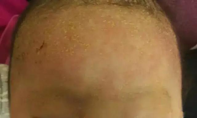 封面 湿疹，皮炎。。。春天最容易出的7种疹子，如何护理？