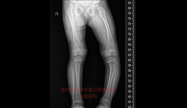 听过“O”型腿、“X”型腿，你见过“D”型腿吗？
