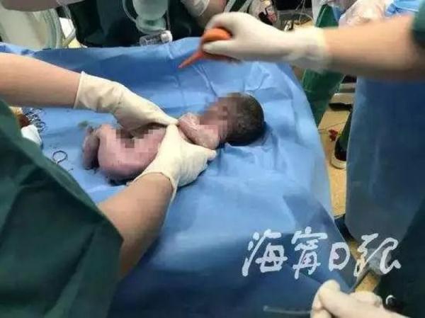 婴儿早产奄奄一息 父亲放弃前说想进去再看一眼