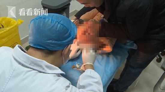 孩子常喊“屁股疼”还有血 医生：零食吃多了脱肛