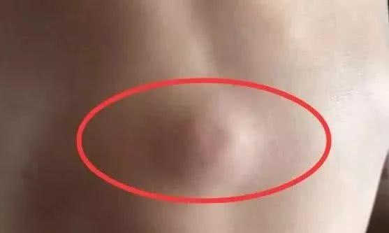 男孩身上鼓起会移动的大包，医生拿刀划开竟然都是虫