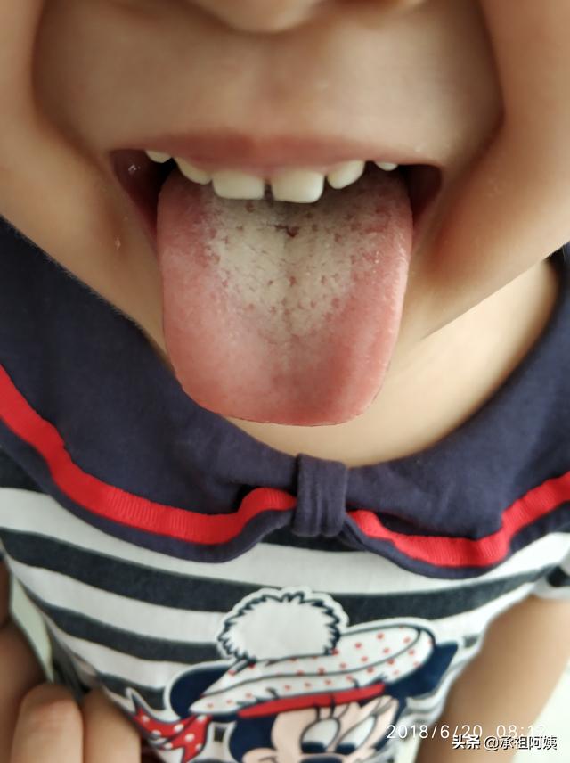 孩子积食内热大，简单几招妈妈们都能做到