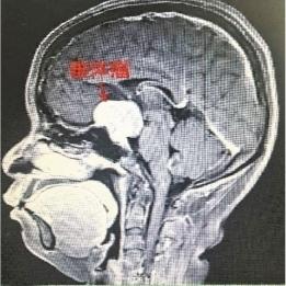 高龄孕妈视力陡降强忍生子 产后方知患上妊娠期垂体瘤