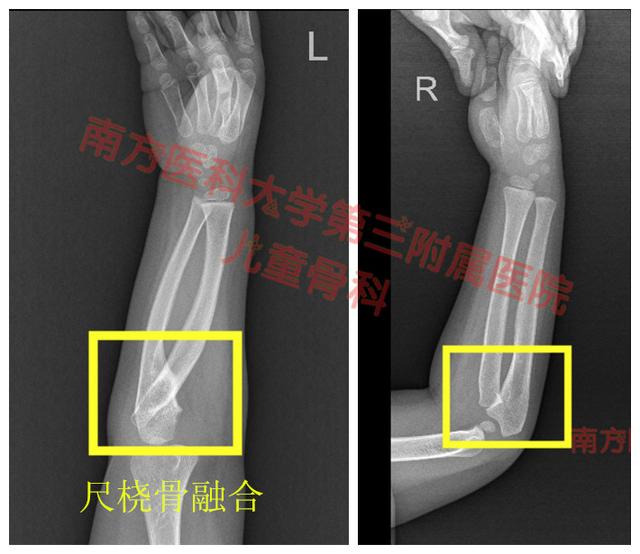 孩子5岁了，却一直用不了筷子