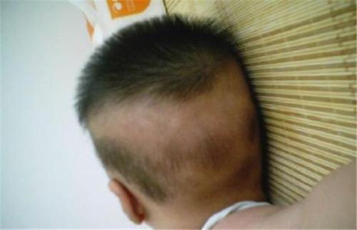 小宝宝出现枕秃、夜啼，是不是需要补钙了？