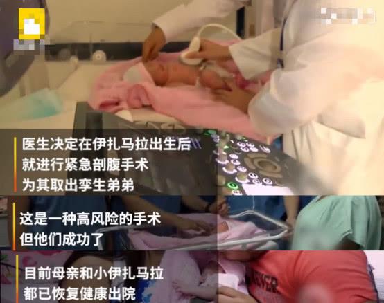 女婴“生”下没有内脏的孪生弟弟，发生率仅为百万分之一