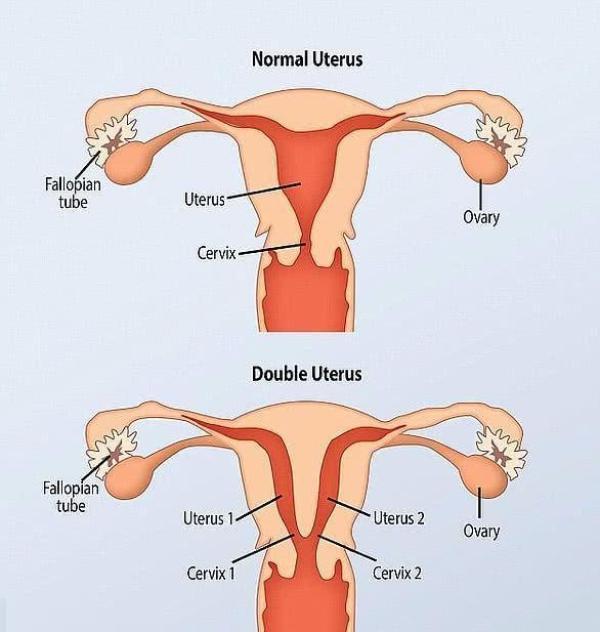 孟加拉一孕妇产子后发现有两个子宫，几周后又生下龙凤胎