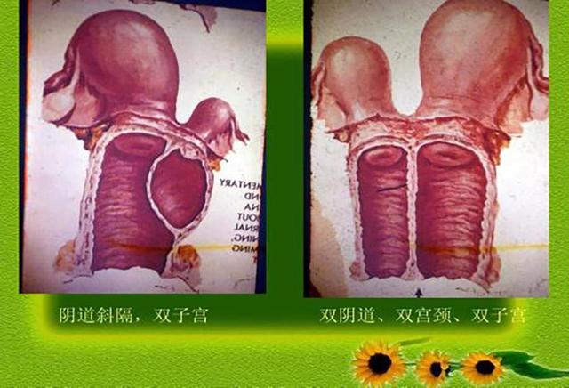 双子宫女性怀孕，将经历什么？江西的“双子宫妈妈”创造了奇迹