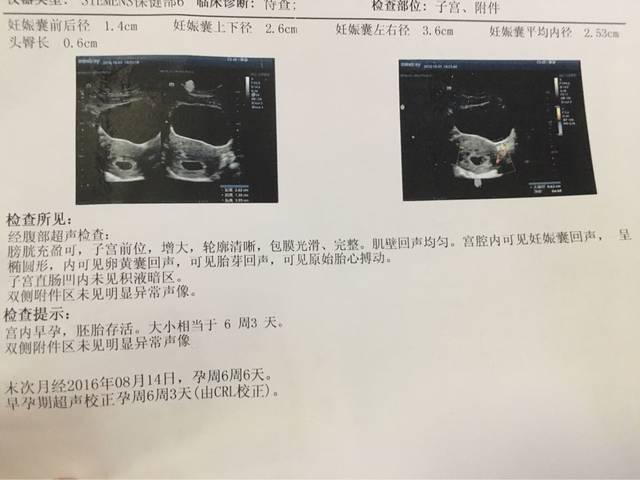 B超检查单上的怀孕时间和计算的不一样，预产期按哪个？