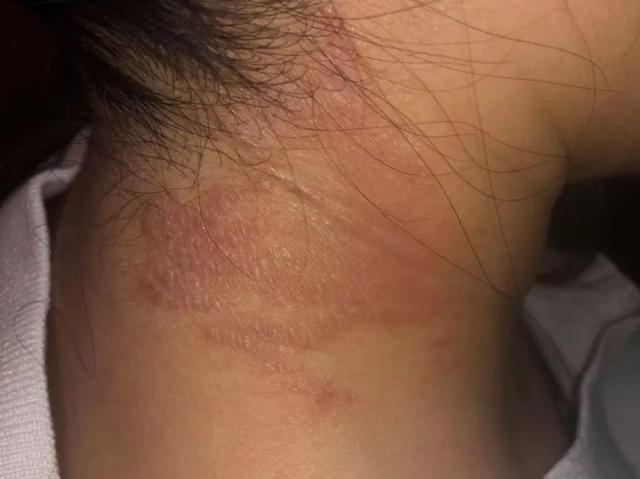 春天最高发的皮肤问题，成人孩子都备受困扰，痒到让人抓狂