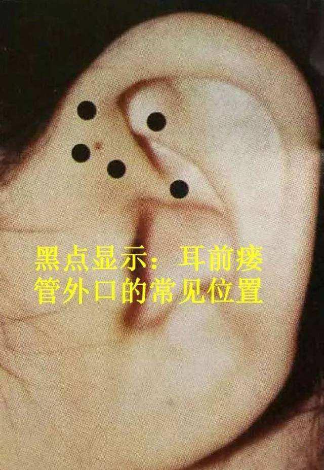 宝宝耳朵边上有个小洞？小心护理不当有害健康！