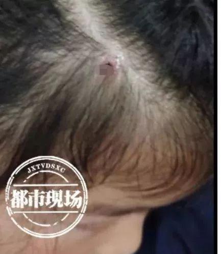 孩子头部发痒，家长拨开头发一看吓坏了…春天千万要注意！