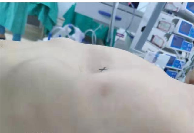 30分钟！河南首例漏斗胸Wang手术成功实施！