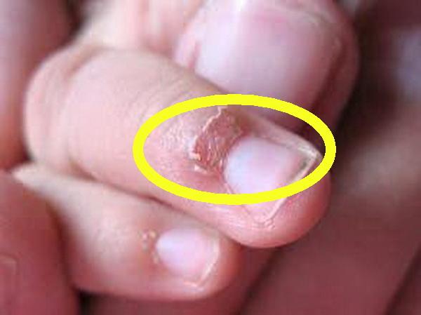孩子手上长倒刺，是身体缺啥吗？原来通过手指可以看出这么多秘密