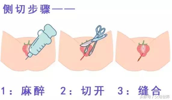 撕裂还是侧切？不想顺产时遇到，掌握这个小技能，赶紧动起来吧！