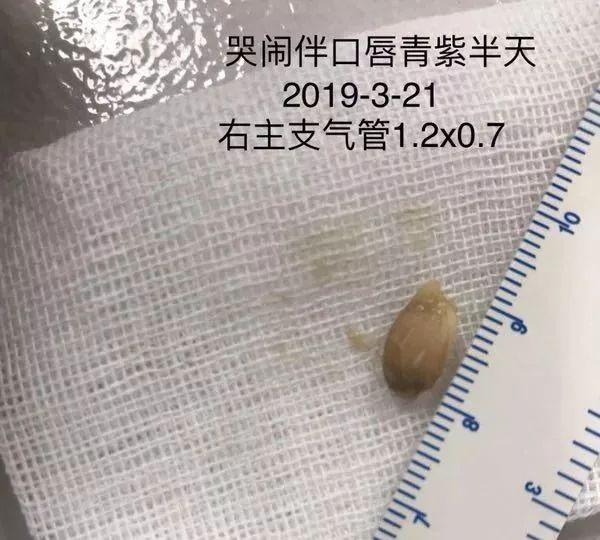 熟睡中被2岁姐姐喂了一片橘子，半岁宝宝差点丢了性命