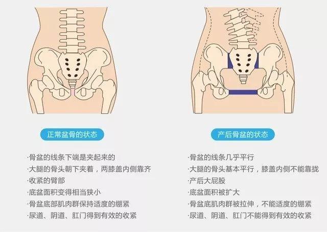 每个产妇都要做“骨盆修复”？这个市场太黑了！