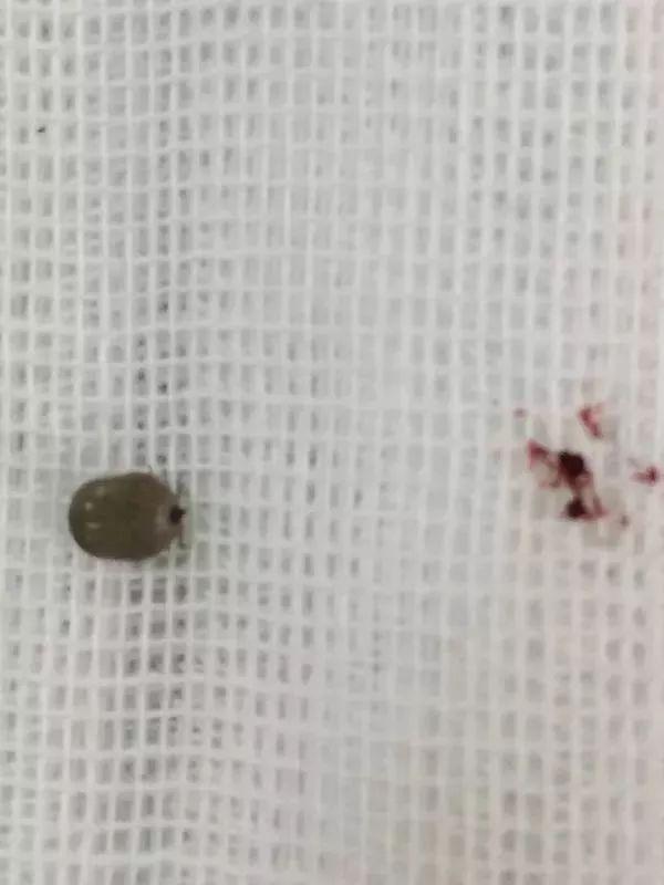 扫墓回来，4岁男孩突然耳孔痛！手电筒一照，家长魂都吓飞...这东西要命啊！