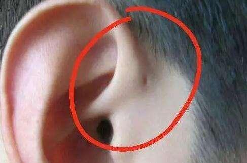 宝宝耳朵边上有个小洞，你还以为这是“聪明孔”？