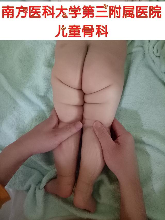 6岁孩子跛行严重，原来父母忽视了这点