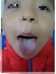 孩子长期鼻塞，舌苔白厚腻，大便臭，前干后稀，如何调理