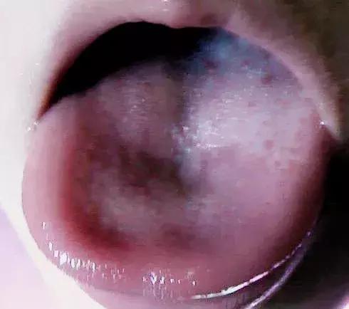 那个鼻炎、过敏的孩子，错误治疗后脾胃受损，6年多终于熬出来了