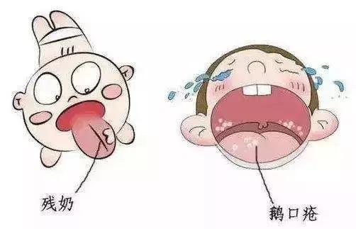宝宝嘴里的“奶块”擦不掉！竟然是感染了这种真菌！